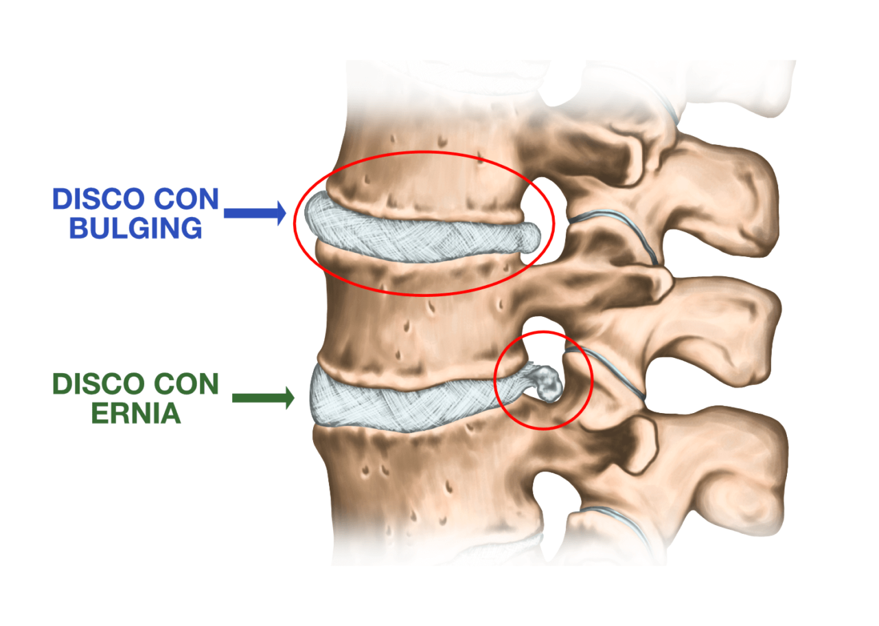 Bulging Discale Il Ruolo Della Rieducazione Posturale