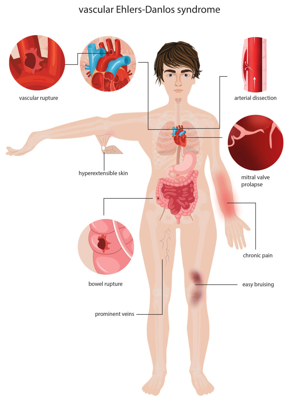 Sindrome di Ehlers-Danlos